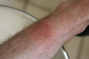 Post-tick rash